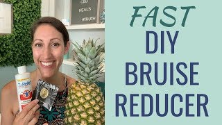 DIY Natural Bruise Treatment | How to Get Rid of a Bruise Fast | Best Home Remedy for Bruises