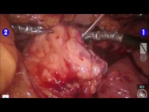 Robotic Assited Duval Procedure for Pancreas Divisum and Cystic neoplasm