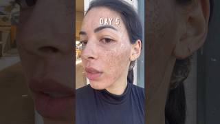 I tried laser resurfacing at The Face Bar ?​⁠@DrNatashaCook #partnership #brandedcontent