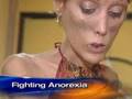 Anorexia's Childhood Roots (CBS News)