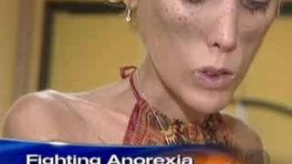Anorexia&#39;s Childhood Roots (CBS News)