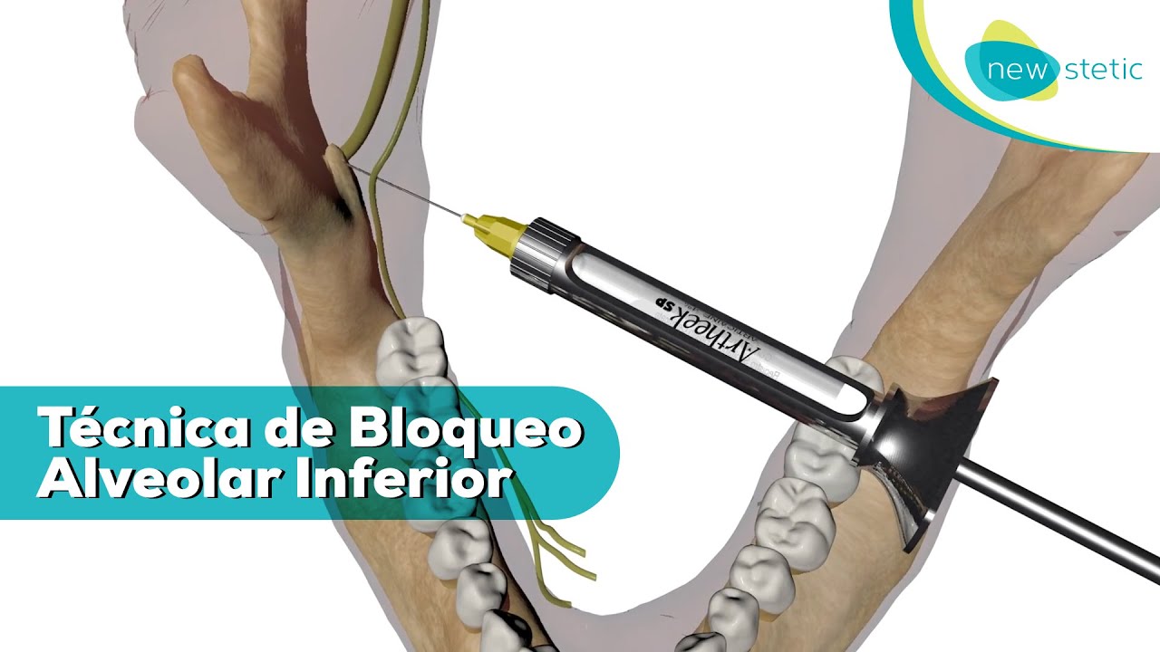 Técnica de bloqueo alveolar inferior 💉 🦷 | New Stetic S.A.
