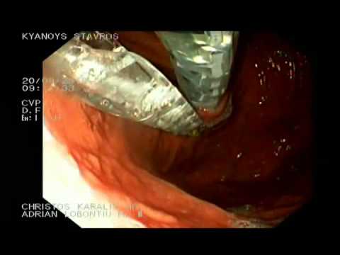 Esophyx - funduplicatura endoscópica, parte 1