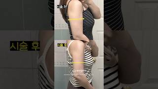 에이빼주사로 뼈말라 되기 🤍