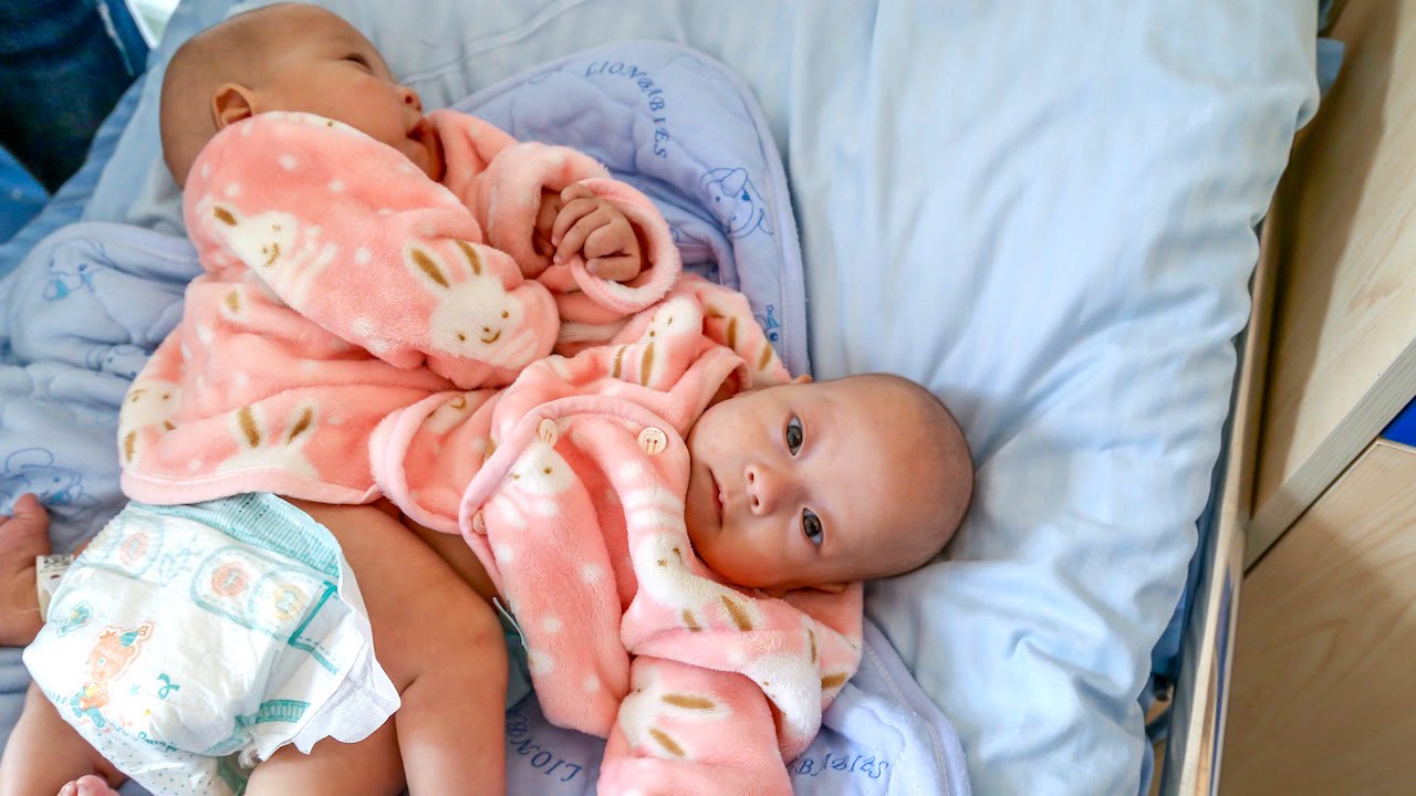 Two Precious: Conjoined Twins Separated Using 3D Tech
