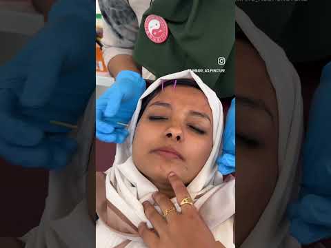 COSMETIC ACUPUNCTURE | RAHMANS ACUPUNCTURE, PANDIKKAD | ACUPUNCTURE