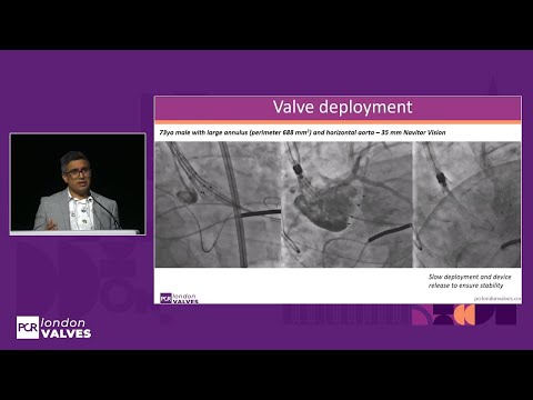 How to optimise TAVI outcomes in extreme patient anatomies? - PCR London Valves 2025