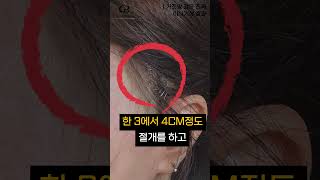 미니 안면거상술 성형 시술
