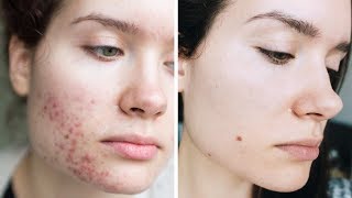 Acne Skincare + Overnight Tips & Tricks | How To Stop Picking Pimples