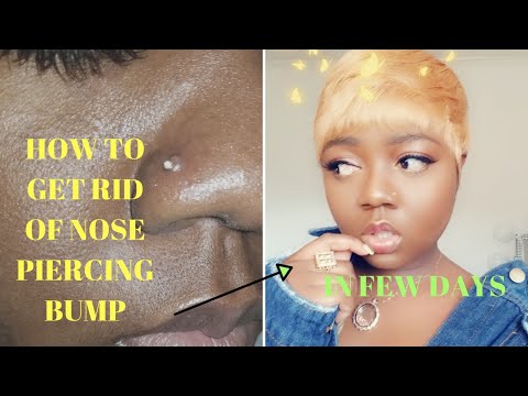 HOW TO GET RID OF NOSE PIERCING BUMP ( SUPER FAST AND...