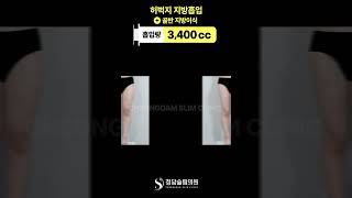 허벅지 지방흡입+골반 지방이식 전후