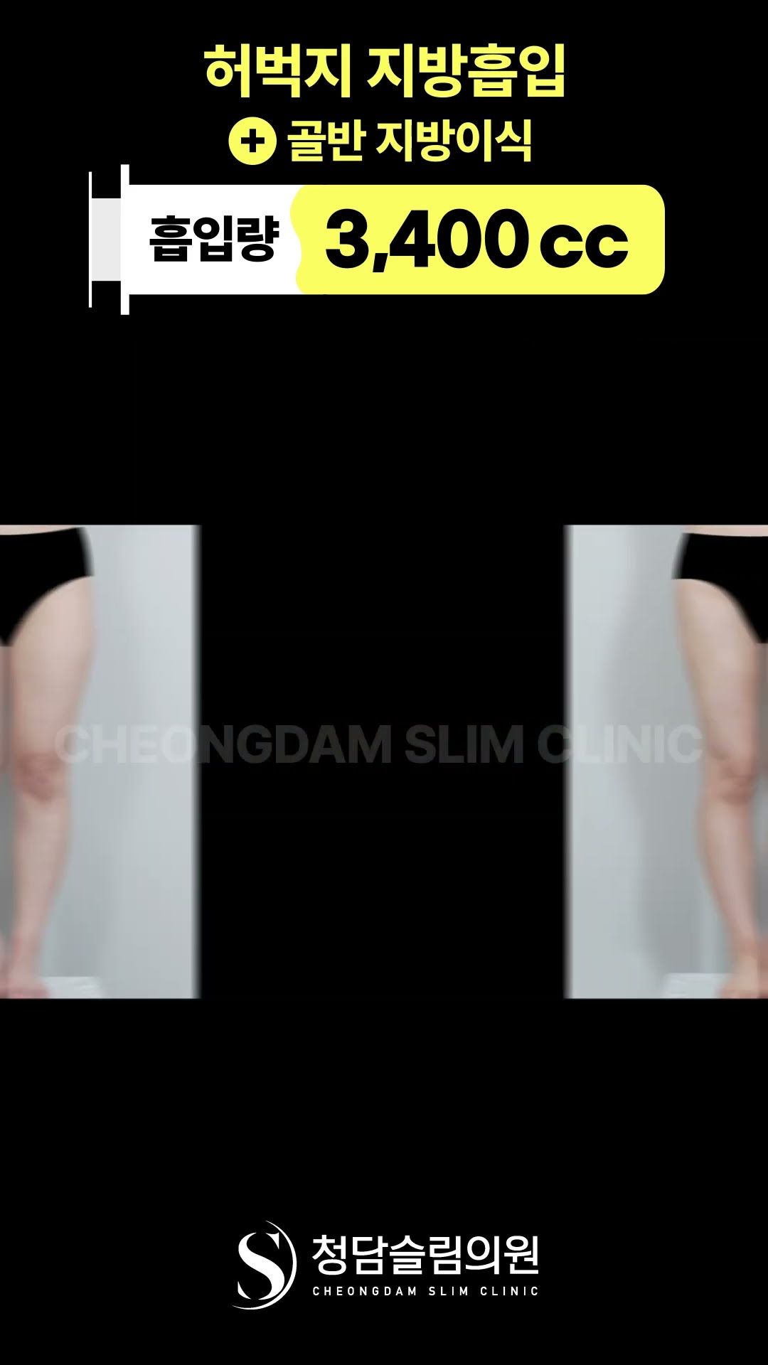 허벅지 지방흡입+골반 지방이식 전후