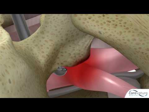 Foraminal decompression utilizing Dreal® technology