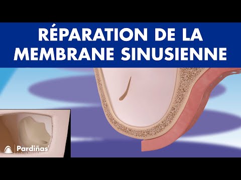 Réparation de la membrane sinusienne ©