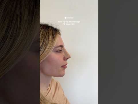 Nose taping and massage 10 days after | Dr.med. Simon Zimmermann
