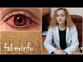 Офтальмолог про ВРЕД капель Визин и КРАСНЫЕ ГЛАЗА / Синдром сухого глаза ...