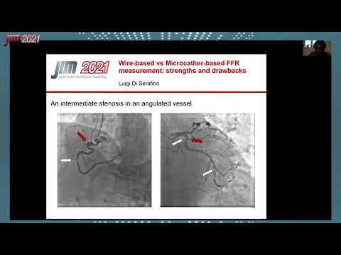JIM 2021 Contemporary Adoption of Invasive Coronary Physiology with Microcatheter Based Technology