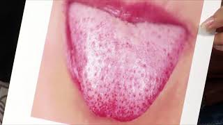 Conoce y aprende los diagnósticos en la lengua.