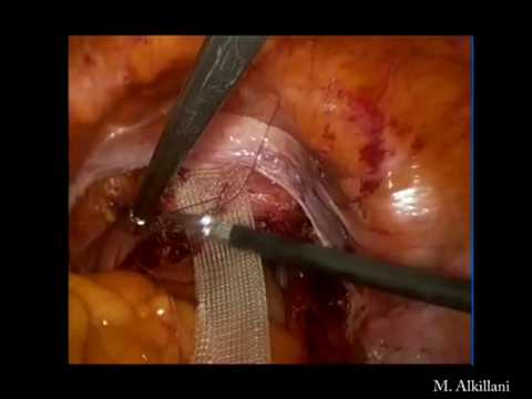 Minimally Invasive Uterus Removal With Suture Of Vagina With A Poypropylene Thread To The Abdominal Wall