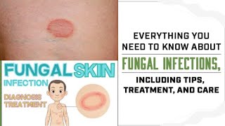 Fungal infection treatment at home | Best fungal infection cream | #ringworm | #fungalinfection