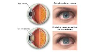 ✅Cirugía Lasik y de Cataratas - Dudas Frecuentes | Dr. Ruiz Mesa - Ramón Ruíz Mesa