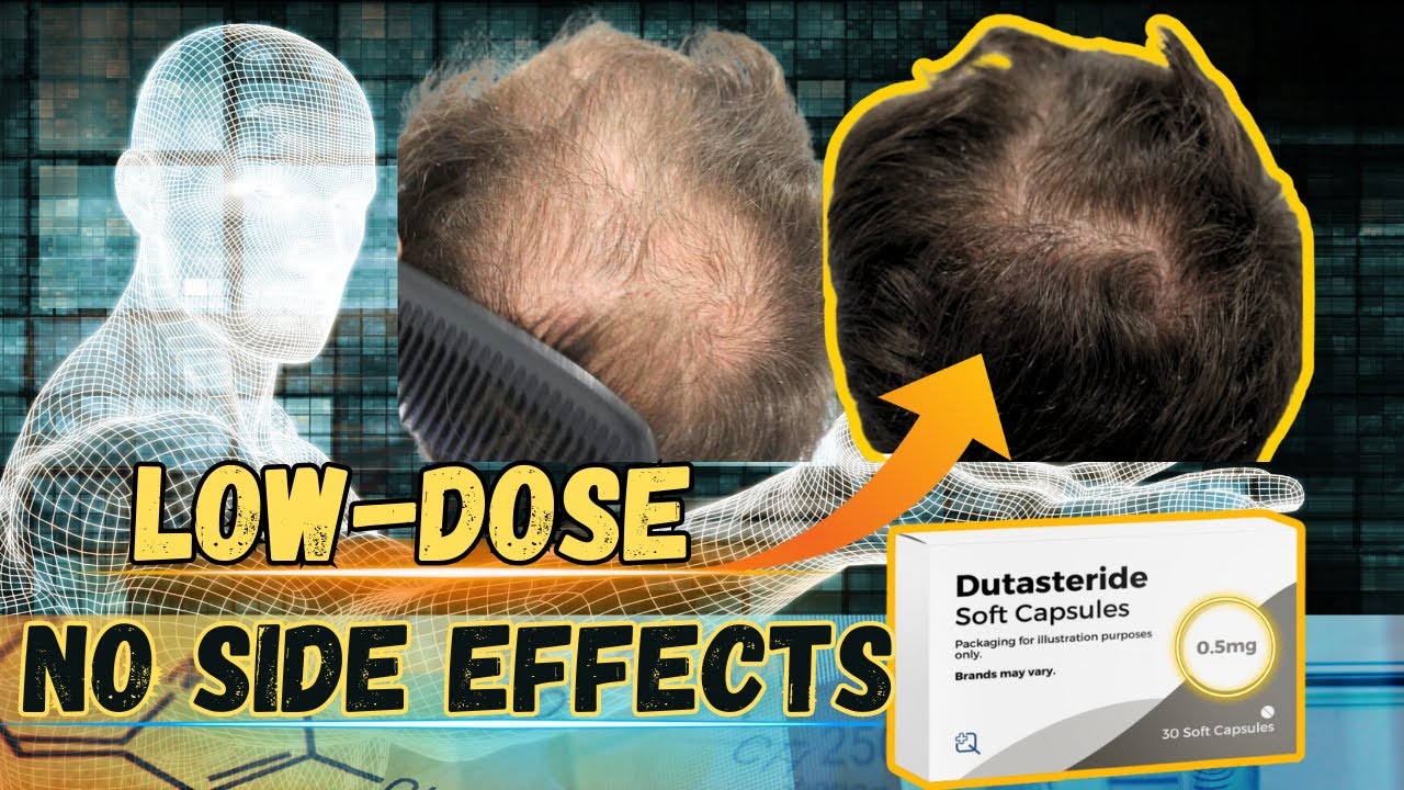 Low-Dose Dutasteride is Safer Than Finasteride