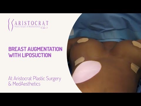 Breast Augmentation with Liposuction