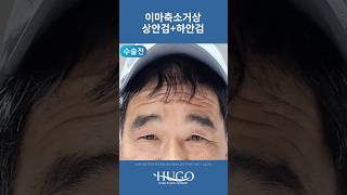 이마 리프트 성형 시술