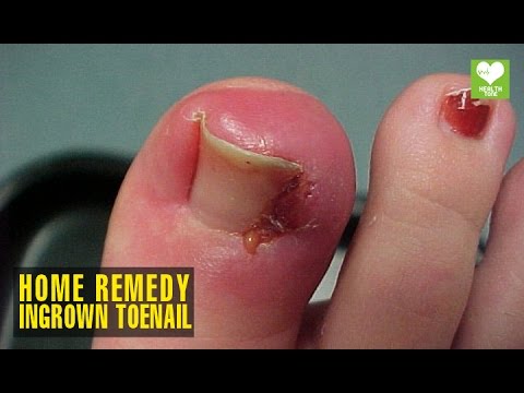 Paano upang gamutin ang isang halamang-singaw na may isang miyembro Folk remedyo para sa balat ng halamang-singaw mabilis
