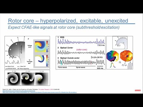 Customized ablation for atrial fibrillation combining pulmonary veins, rotors, CFAEs, and lines