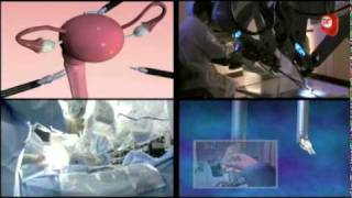 Vídeo El Robot Da Vinci, ahora en el Grupo Hospital de Madrid