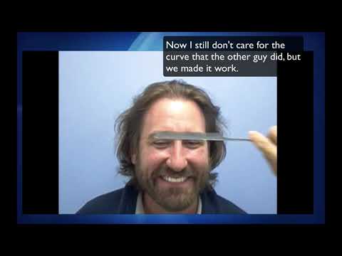 Another repair hair transplant in DC by Dr. Lindsey, with video interview of patient | McLean | VA thumbnail
