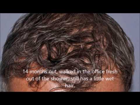 Outstanding results 2 years out from Hair transplant Dr. Lindsey | McLean | VA | Virginia | MD | DC thumbnail