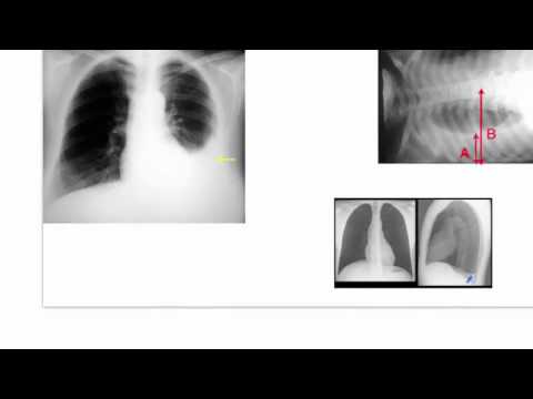 Dressler Syndrome (Post Cardiac Injury Syndrome)