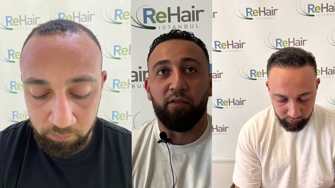 ReHair Istanbul Eind Resultaat  - Haartransplantatie Turkije