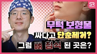무턱 보형물 부작용 후기, 제거 방법은?