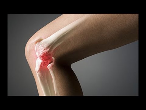Артроз коленного сустава. Как укрепить колени