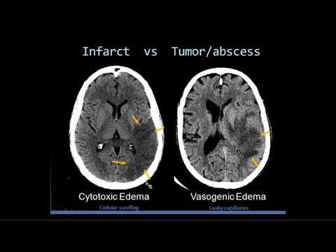Intro to Head CT Part II: Evaluation of Ischemic Stroke