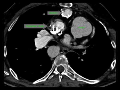 Transposition Great Arteries, UCLA