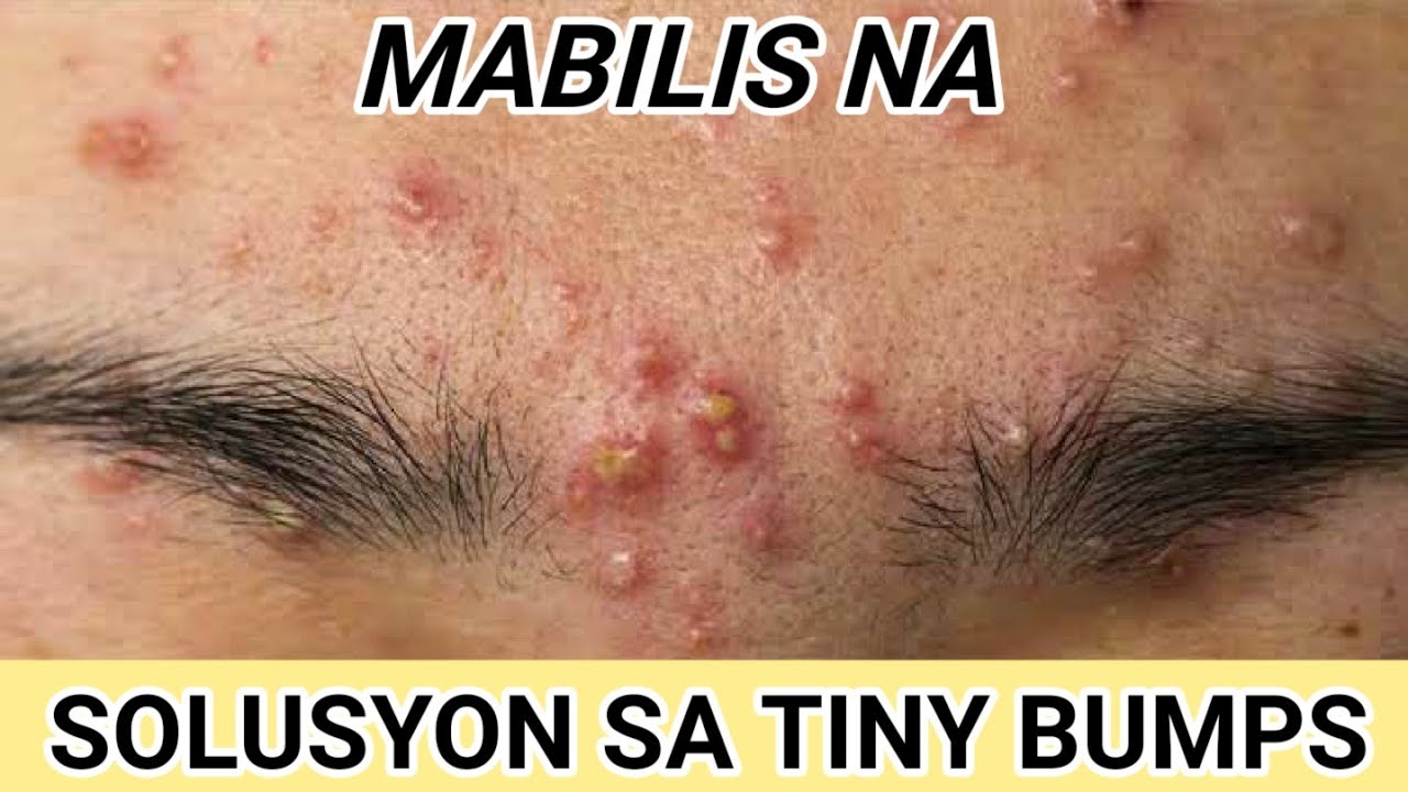 PAANO MAALIS ANG TINY BUMPS OR BUTLIG-BUTLIG SA MUKHA
