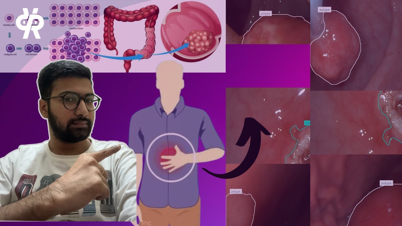 YOLO11 Endoscopy Image Analysis: Train Custom AI Model for Medical Image Segmentation