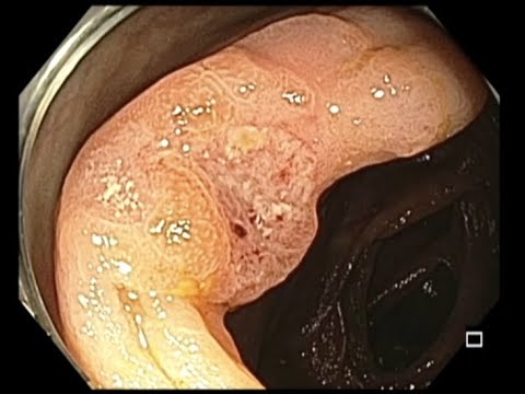 Colonoscopy: Ascending Colon Cancer - What is the Sequence of Biopsy, Tattoo, etc.