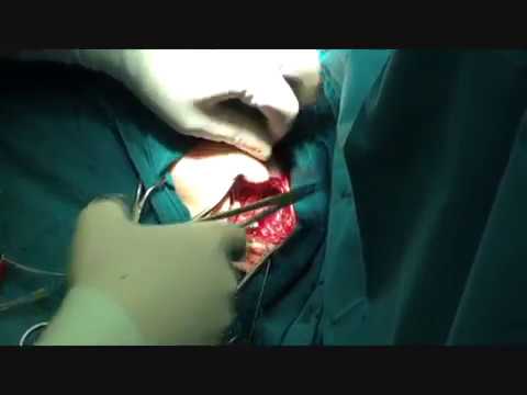 HLS ricette da dolori articolari Osteocondrosi delleffetto sugli organi interni