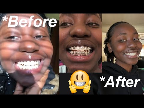 My Braces Journey (From Start To Finish)