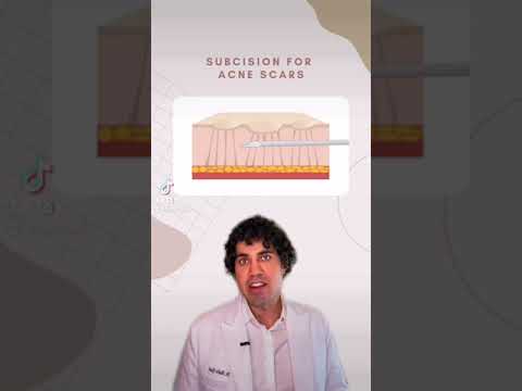 Learn More About Subcision Treatment for Acne Scars By Dr. Nadir Qazi