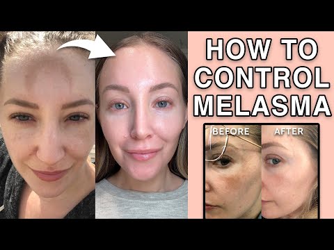 So behandeln Sie Melasma zu Hause und mit Mini-Fraxel