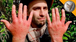 Worst Insect Stings EVER!