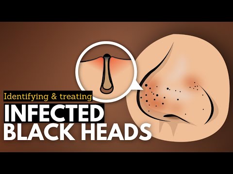 Effects of Cannabis on your body