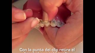 ¡Tengo suelto un brackets y me lastima! ¿Qué hago | Cuidados de Emergencias de Ortodoncia en casa |