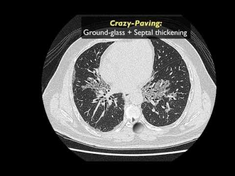 RADIOLOGY BITS (INTERACTIVE SNAPCHAT CASE 1 DISCUSSION)